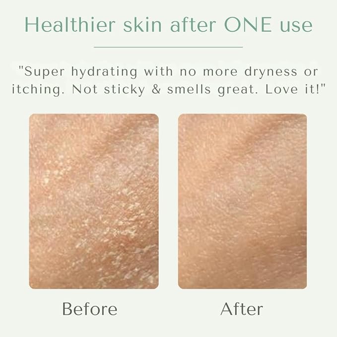 Yobee Body & Face Cream for Dry, Itchy Skin, Eczema & Psoriasis, Dermatologist Formulated, Probiotics, Honey, Turmeric, Vitamins B12 & E, Ceramides, Shea Butter, Fragrance Free, For Kids & Adults