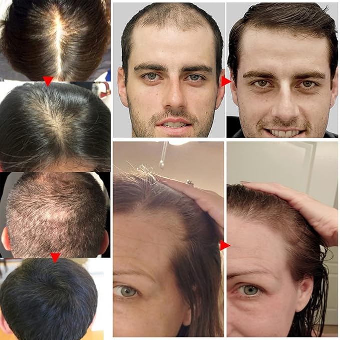 Biotin Hair Growth Serum for Hair Loss Treatment and Regrowth - Natural Ginger Essential Oil for Stronger, Thicker and Longer Hair for Women & Men (1.0 Fl Oz / 30ML)