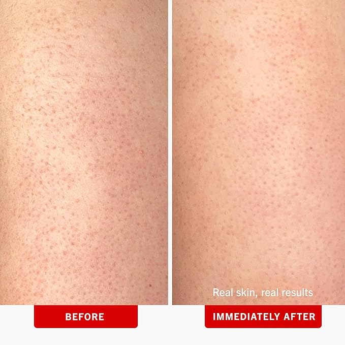 First Aid Beauty - KP Bump Eraser Body Scrub with 10% AHA, Keratosis Pilaris Exfoliator with Glycolic and Lactic acids, Helps Reduce Chicken Skin Bumps, Safe for Sensitive Skin, Strawberry Scent, 2 oz