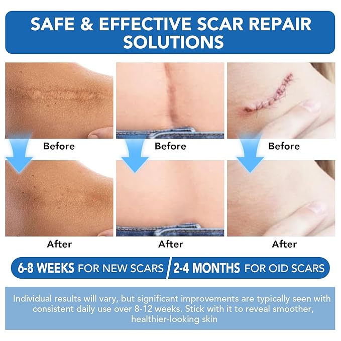 Silicone Scar Sheets, Silicone Scar Tape(1.6"x 60" Roll-1.5M) - Reusable, Soft & Medical Grade Adhesive Tape for Old & New Scars, C-Section, Surgery, Keloid & Acne Scars