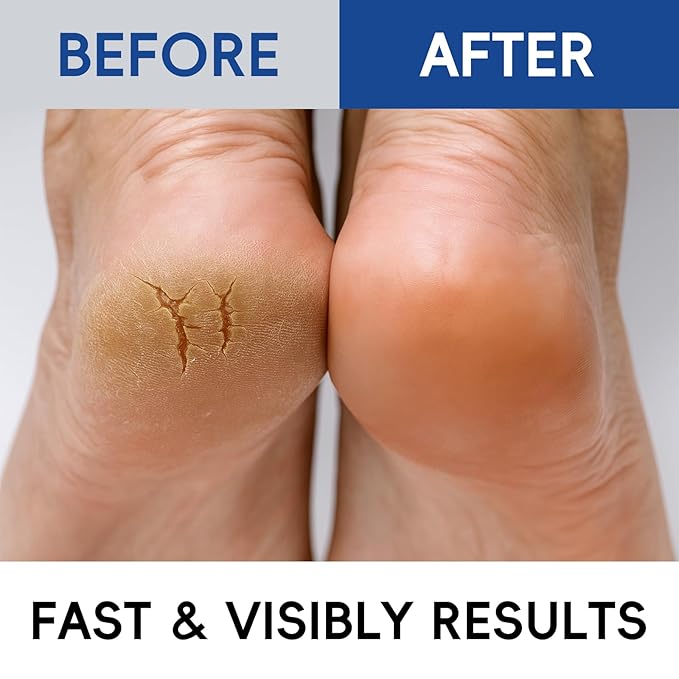 2 Pack Urea Cream 40% + 2% Salicylic Acid, 3.53 oz - Maximum Strength Foot & Hands Moisturizer for Rough, Dry Cracked Skin, Callus Remover with Deep Hydration, Intensive Repair for Feet, Heels