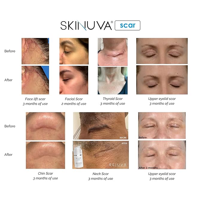 Skinuva® Next Generation Scar Cream - Stretch Mark Cream Made with Growth Factors, Hyaluronic Acid & Vitamin C for Intense Stretch Mark Removal (2.5 oz)