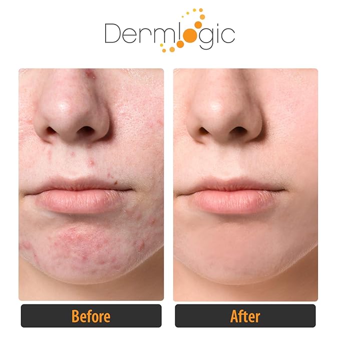 Acne Treatment Pads-Contains Glycolic, Lactic, Salicylic Acid. Eliminates Oily Skin, Clogged Pores & Cystic Breakouts. Removes Dark Spots, Whitehead & Blackhead Pimples for Face & Body.