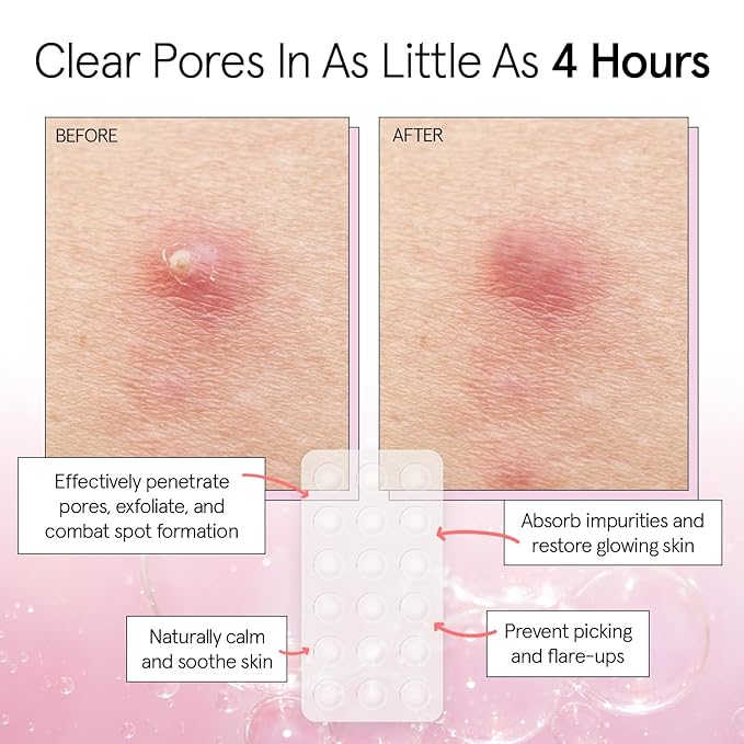grace & stella Award Winning Multi-Size Pimple Patches for Face - Dermatologist Tested Acne Patches for Face - Hydrocolloid Patch for Breakouts, Whiteheads - Vegan Pimple Patch (Clear, 72 Pack)