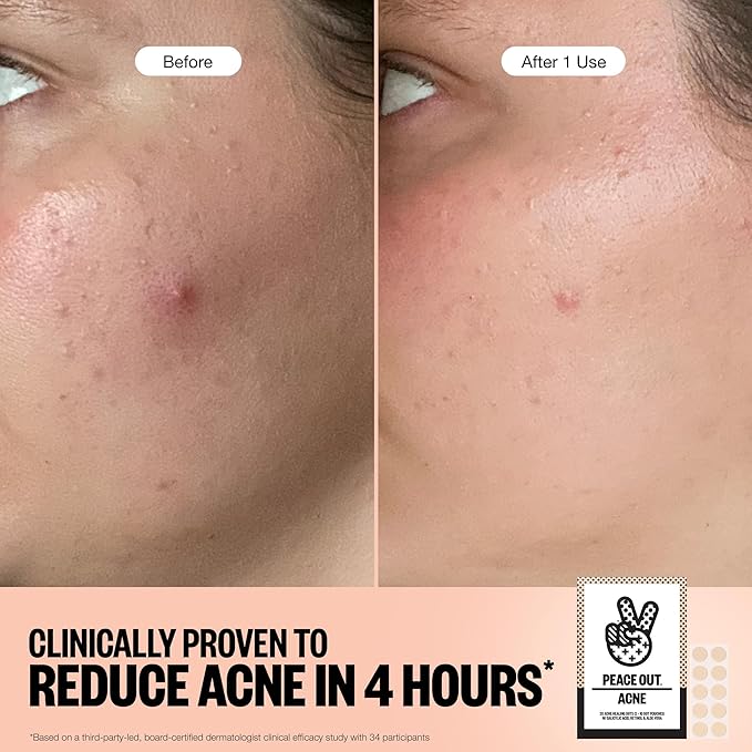 PEACE OUT Acne Healing Dots Helps Clear Blemishes Overnight, Fast Acting Hydrocolloid Pimple Patches for Breakouts with Salicylic Acid, Retinol and Aloe Vera, Award Winning Skincare Solution 60 Count