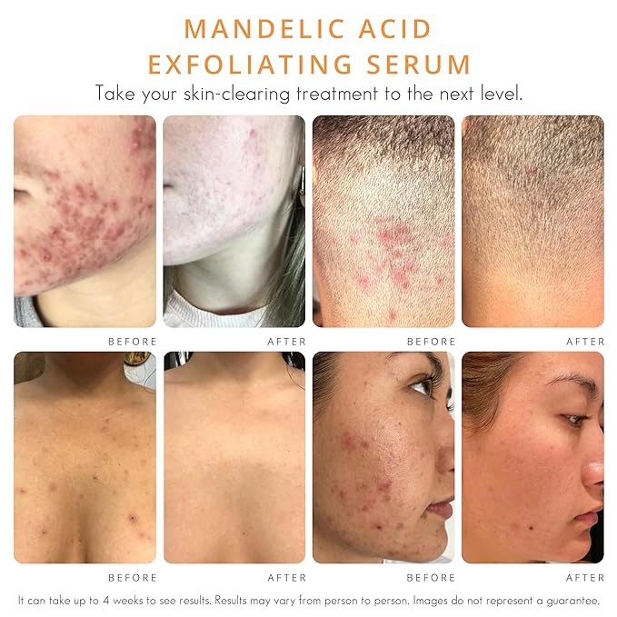 Almond Clear Level 1 Serum | Mandelic Acid Facial Serum for Acne, Folliculitis, Aging Skin, Ingrown Hairs, Dark Spots on Face, Chest, Butt, Back, Thighs, Arms | 4oz