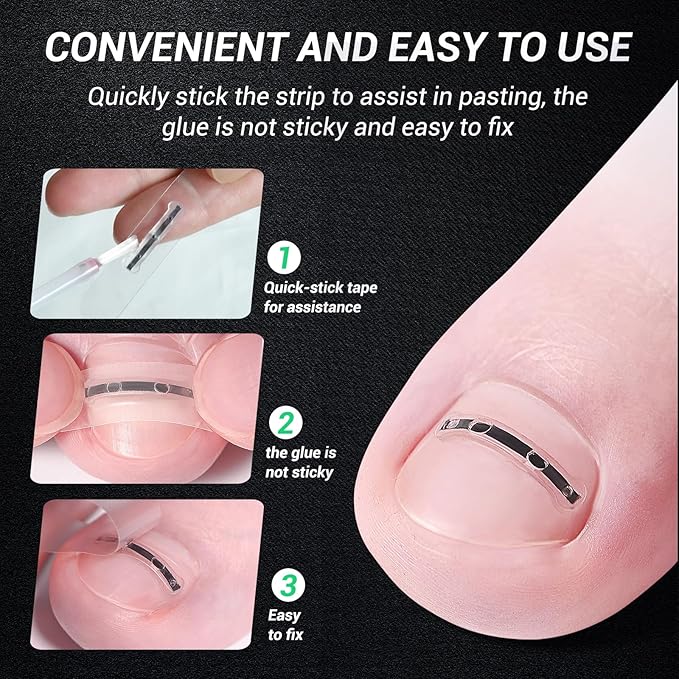 Titanium Alloy Ingrown Toenail Treatment, Nail Tools, and Ingrown Toenail Removal Kit Specially Designed for Curved Nail Repair and Ingrown Toenail Corrector (0.59/0.67in)