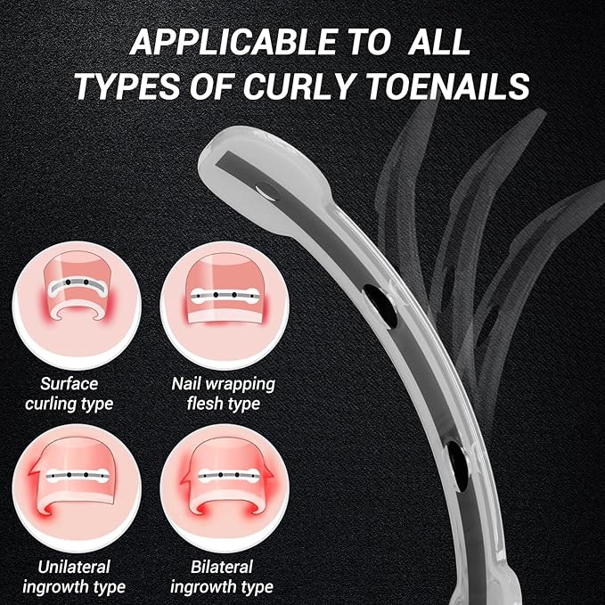 Titanium Alloy Ingrown Toenail Treatment, Nail Tools, and Ingrown Toenail Removal Kit Specially Designed for Curved Nail Repair and Ingrown Toenail Corrector (0.59/0.67in)